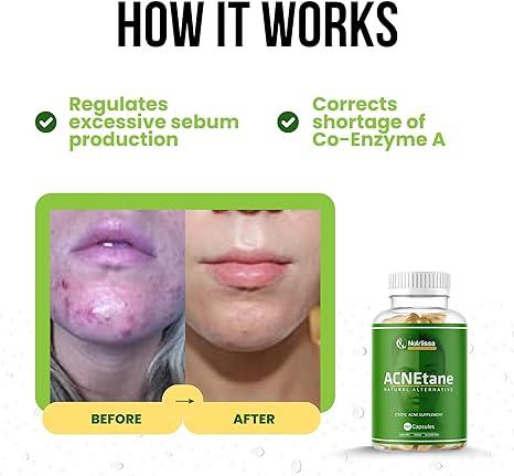 vitamine a supplement acne